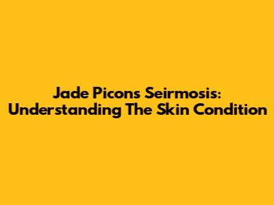 Jade Picon's Seirmosis: Understanding The Skin Condition
